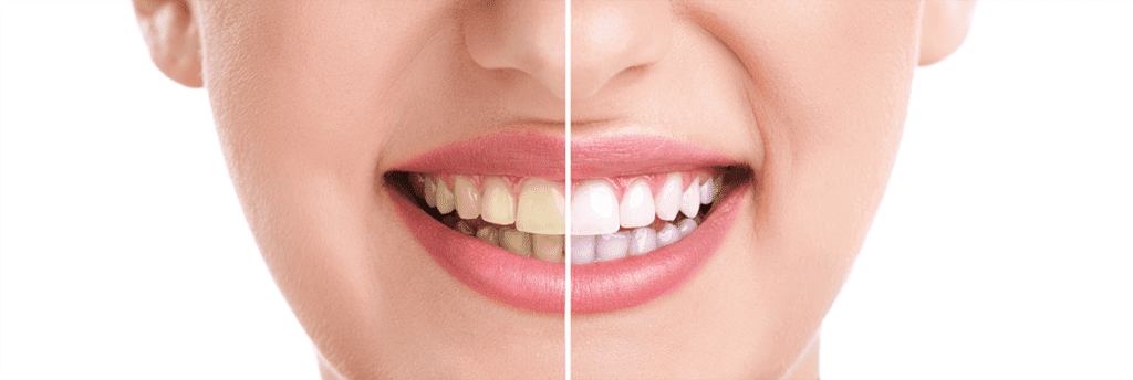 teeth-whitening