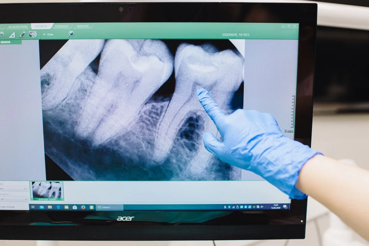 Gloved hand pointing to a tooth on a dental X-ray to compare healthy and unhealthy teeth
