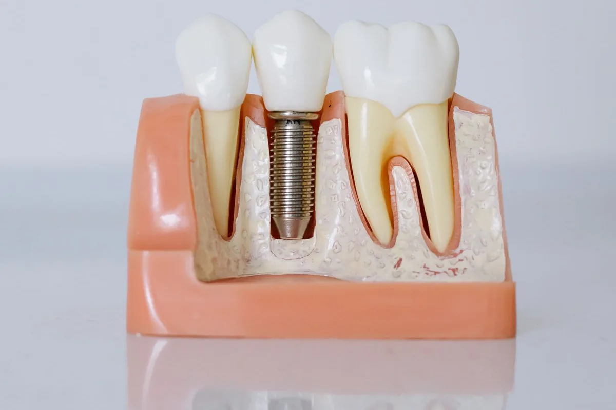 Dental model showing an implant post set in the jawbone between natural teeth