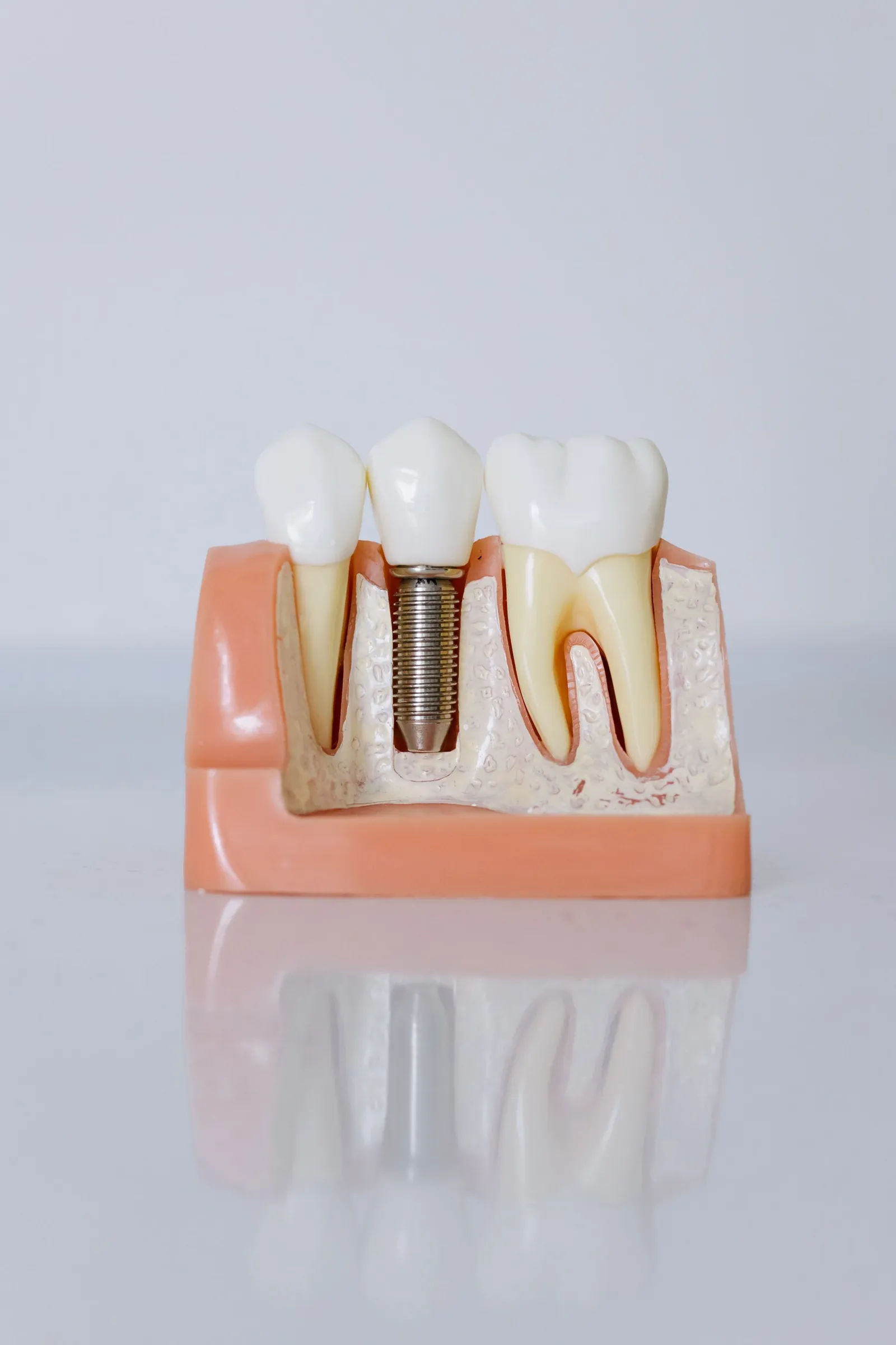 A model showing a dental implant next to natural teeth