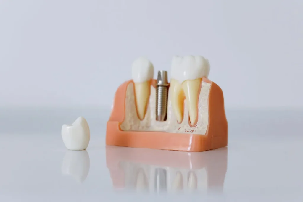 A dental implant model on a light background
