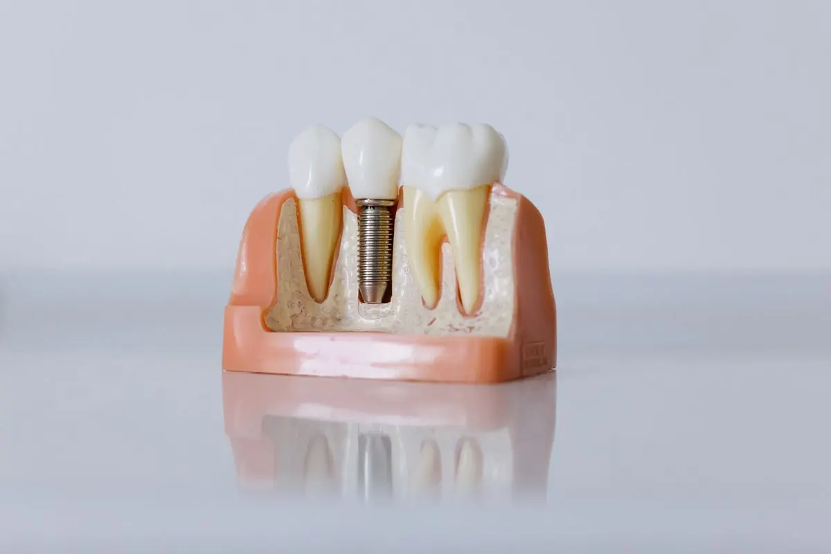Dental implant model showing the post, abutment and crown that make up dental implant cost